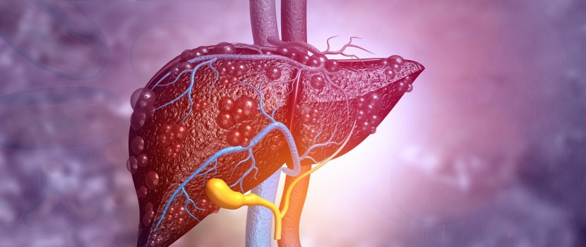 Haemochromatosis